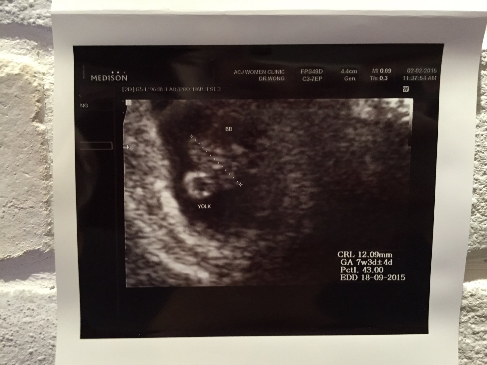 My First BB scan